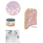 Nosocomial Infections: Characteristics of Gram-negative (Pseudomonas) Pneumonia