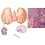 Hashimoto's Thyroiditis