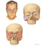 Facial Trauma: Clinical Findings In Zygomatic and Naso-Orbital Injuries