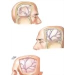 Traumatic Aneurysms of Meningeal Arteries