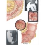 Inflammatory Bowel Disease: Moderately Severe Inflammatory Bowel Disease - Pathologic Features