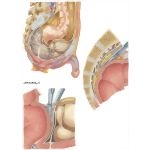 Inflammatory Bowel Disease: Surgical Removal of Rectum - Abdominal Phase