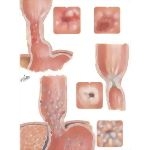 Esophagitis: Varices