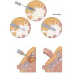 Breast Tumors, Needle Biopsy, and Aspiration