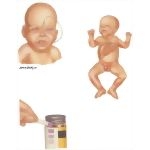 Birth Defects: Disorders of Propionate Metabolism - Signs and Symptoms