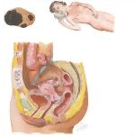 Dysmenorrhea: Primary and Secondary