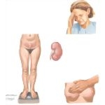 Premenstrual Syndrome