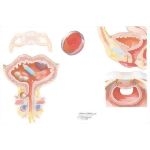 Urinary Incontinence