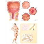 Urinary Tract Infection