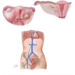Endometritis