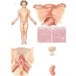 Gonadal Dysgenesis