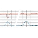 Fetal Heart Rate Testing: Periodic Changes