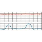Fetal Heart Rate Testing: Tachycardia