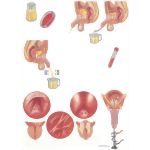 Diseases of Prostate: Evaluation of Overflow Obstruction