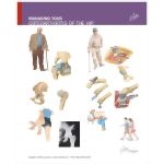 Managing Your Osteoarthritis of the Hip