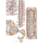 Spinal Fusion