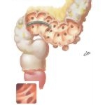 Diverticulosis