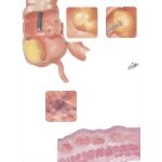 Lipoma: Telangiectasia