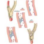 Thrombotic Disorders: Arterial Thrombosis
