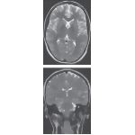 Magnetic Resonance Imaging Of The Ventricles: Axial And Coronal Views