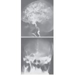 Angiographic Anatomy of the Internal Carotid Artery