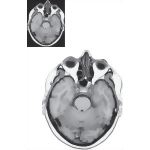 Axial (Horizontal) Sections Through the Forebrain: Level 2 - Rostral Pons