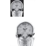 Coronal Sections Through the Forebrain: Level 7 - Midthalamus