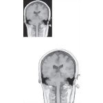Coronal Sections Through the Forebrain: Level 8 - Geniculate Nuclei