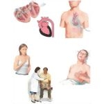 Managing Your Aortic Insufficiency
