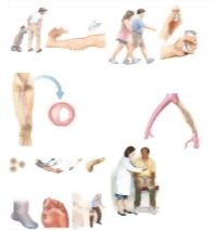 Managing Your Poor Circulation