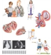 Managing Your Ventricular Septal Defect