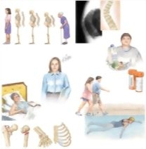 Managing Your Osteoporosis