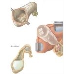 Gallstones: Complications of Calculous Cholecystitis