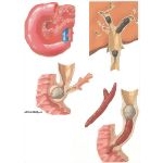 Gallstones: Complications of Calculous Obstruction of Common Duct
