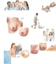 Managing Your Paget's Disease of the Breast