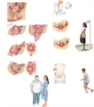 Managing Your Pelvic Organ Prolapse