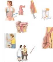 Managing Your Perirectal Abscess