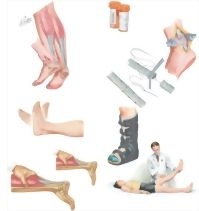 Managing Your Achilles Tendon Rupture