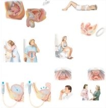 Managing Your Urinary Incontinence