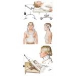 Cervical Spine Injury: Traction and Bracing