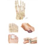 Injury to Metatarsals and Phalanges