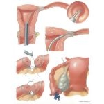 Tubal Factor