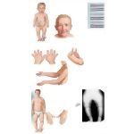 Metaphyseal Chondrodysplasia