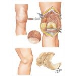 Pigmented Villonodular Synovitis and Meniscal Cysts