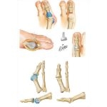Hallux Valgus, Bunion, and Metatarsus Primus Varus