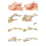 Metacarpophalangeal Deformities of Thumb