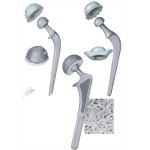 Total Hip Replacement: Prostheses