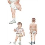 Longitudinal Arrest of the Lower Limb: Phocomelic Type
