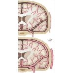 Theory of Migraine Etiology
