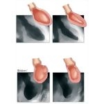 Measurement of Left Ventricular Function Using Ventriculography